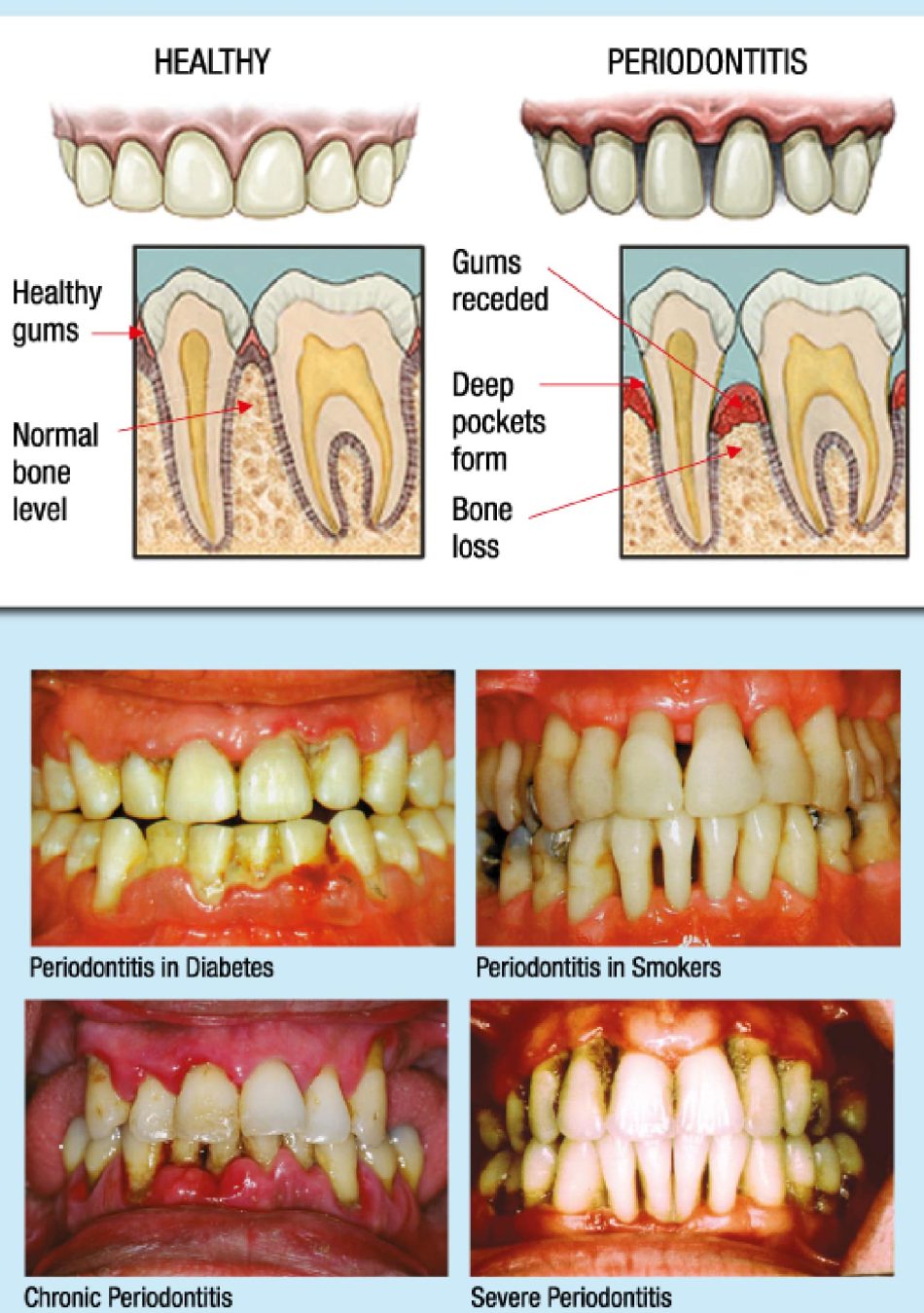 Periodontitis-Diagrams-Pics_For-Web@2x1-min